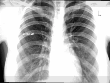 Туберкулез: число случаев растет, регион Лацио среди наиболее пострадавших