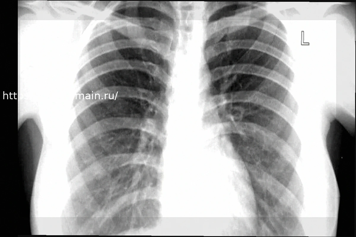 Preview Туберкулез: число случаев растет, регион Лацио среди наиболее пострадавших